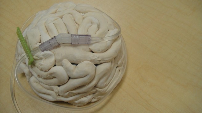 brain aneurism 3 final product